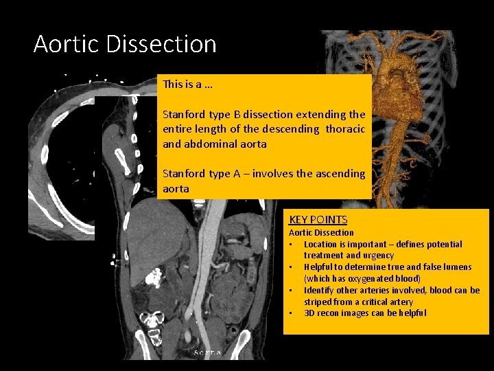 Aortic Dissection This is a … Stanford type B dissection extending the entire length