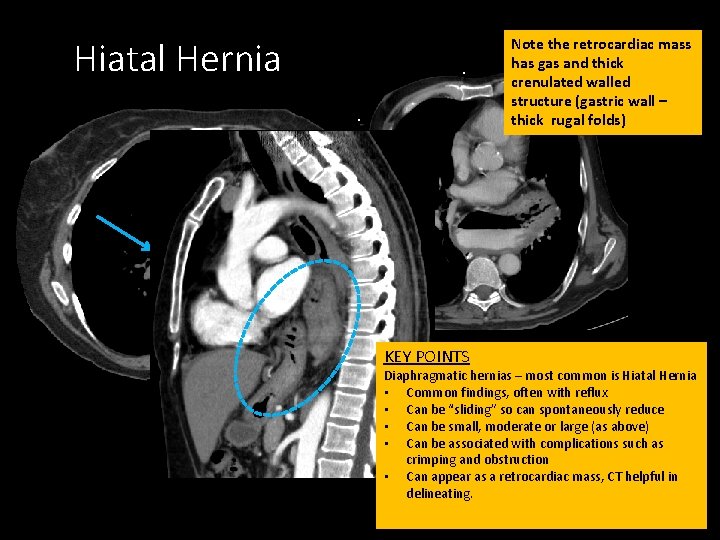 Hiatal Hernia Note the retrocardiac mass has gas and thick crenulated walled structure (gastric