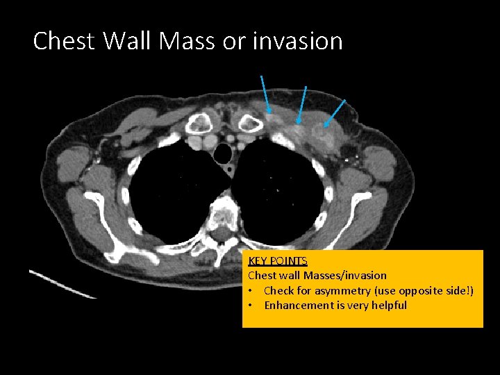 Chest Wall Mass or invasion KEY POINTS Chest wall Masses/invasion • Check for asymmetry