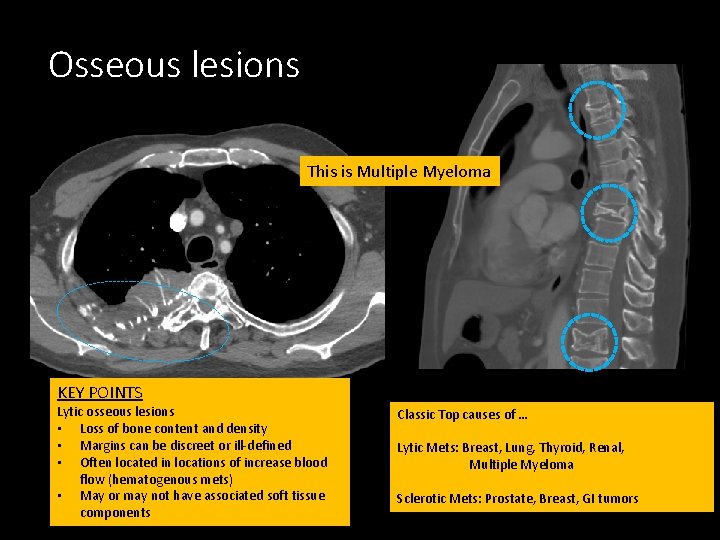 Osseous lesions This is Multiple Myeloma KEY POINTS Lytic osseous lesions • Loss of