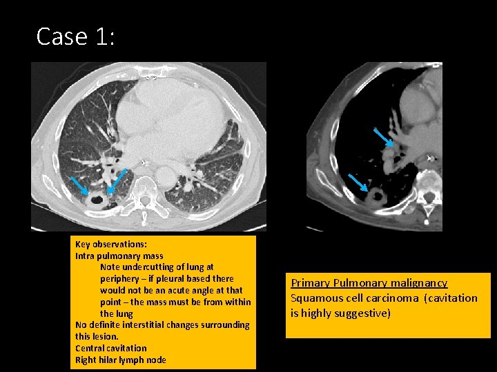 Case 1: Key observations: Intra pulmonary mass Note undercutting of lung at periphery –