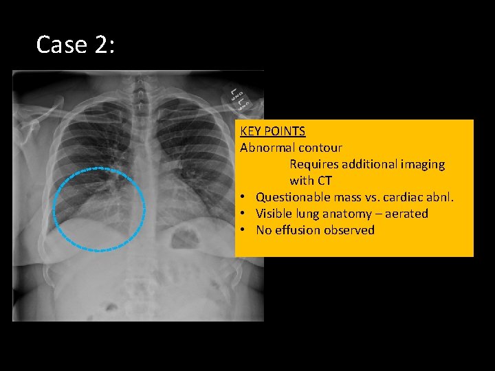 Case 2: KEY POINTS Abnormal contour Requires additional imaging with CT • Questionable mass