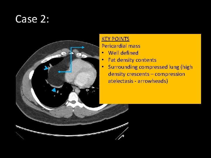 Case 2: KEY POINTS Pericardial mass • Well defined • Fat density contents •