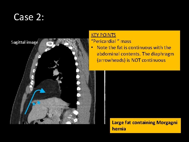 Case 2: Sagittal image KEY POINTS “Pericardial “ mass • Note the fat is
