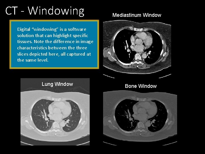 CT - Windowing Mediastinum Window Digital “windowing” is a software solution that can highlight