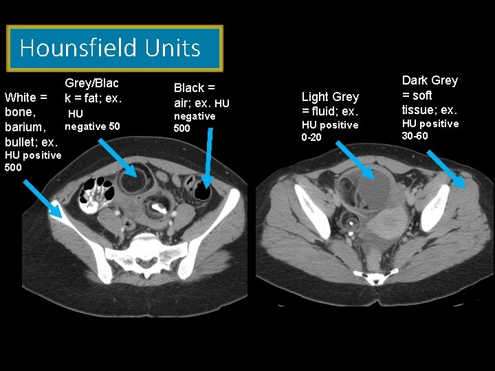 Hounsfield Units Grey/Blac k = fat; ex. White = bone, HU barium, negative 50