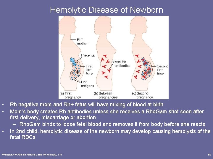 Hemolytic Disease of Newborn • • • Rh negative mom and Rh+ fetus will