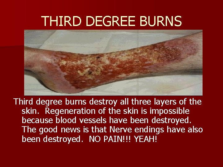 THIRD DEGREE BURNS Third degree burns destroy all three layers of the skin. Regeneration