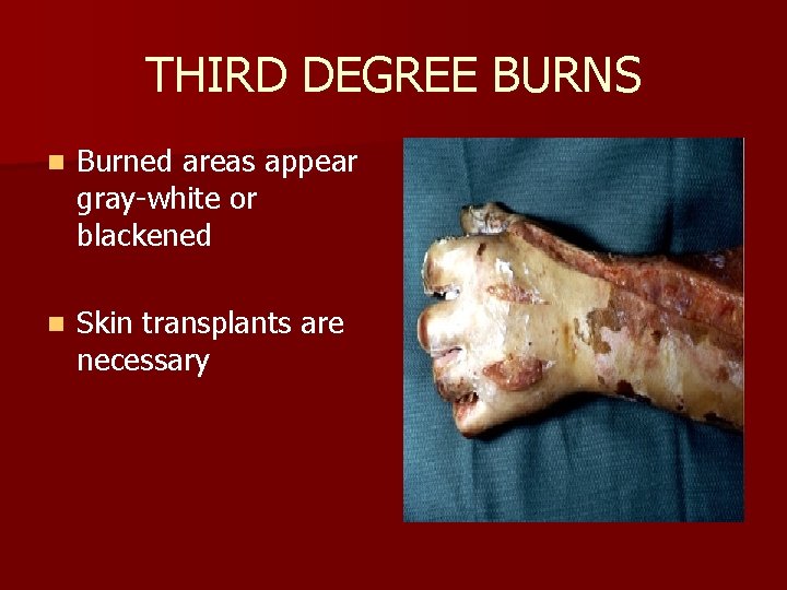 THIRD DEGREE BURNS n Burned areas appear gray-white or blackened n Skin transplants are
