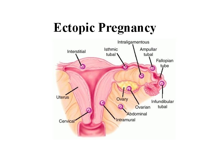 Ectopic Pregnancy 