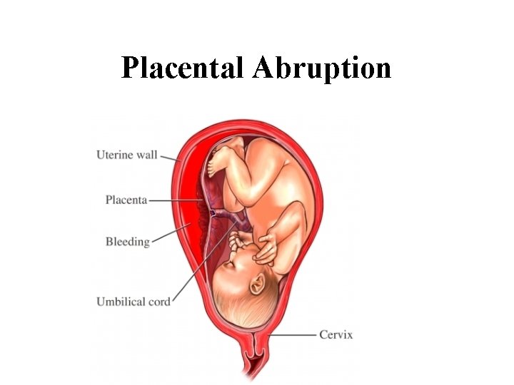 Placental Abruption 