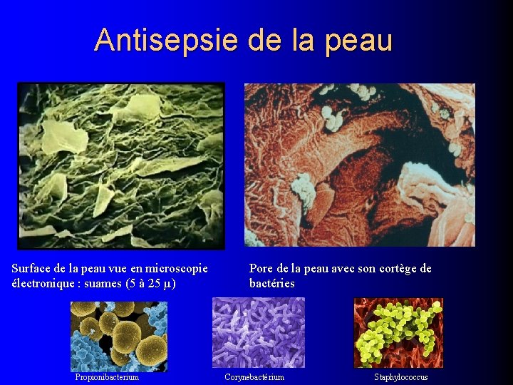 Antisepsie de la peau Surface de la peau vue en microscopie électronique : suames