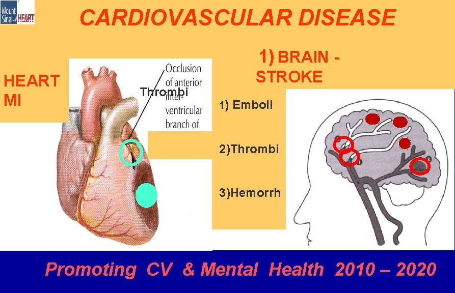 CARDIOVASCULAR DISEASE 1) BRAIN HEART MI Thrombi STROKE 1) Emboli 2 2)Thrombi 3)Hemorrh Promoting