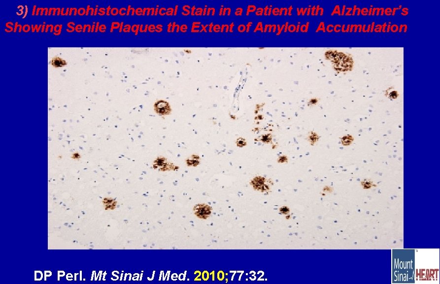 3) Immunohistochemical Stain in a Patient with Alzheimer’s Showing Senile Plaques the Extent of