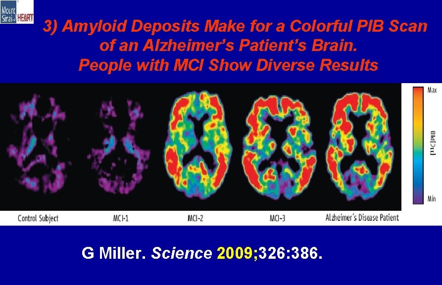 3) Amyloid Deposits Make for a Colorful PIB Scan of an Alzheimer’s Patient’s Brain.