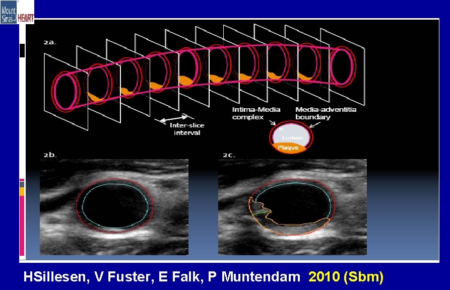 HSillesen, V Fuster, E Falk, P Muntendam 2010 (Sbm) 