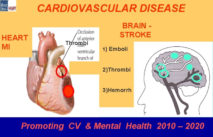 CARDIOVASCULAR DISEASE HEART MI BRAIN STROKE Thrombi 1) Emboli 2 2)Thrombi 3)Hemorrh Promoting CV