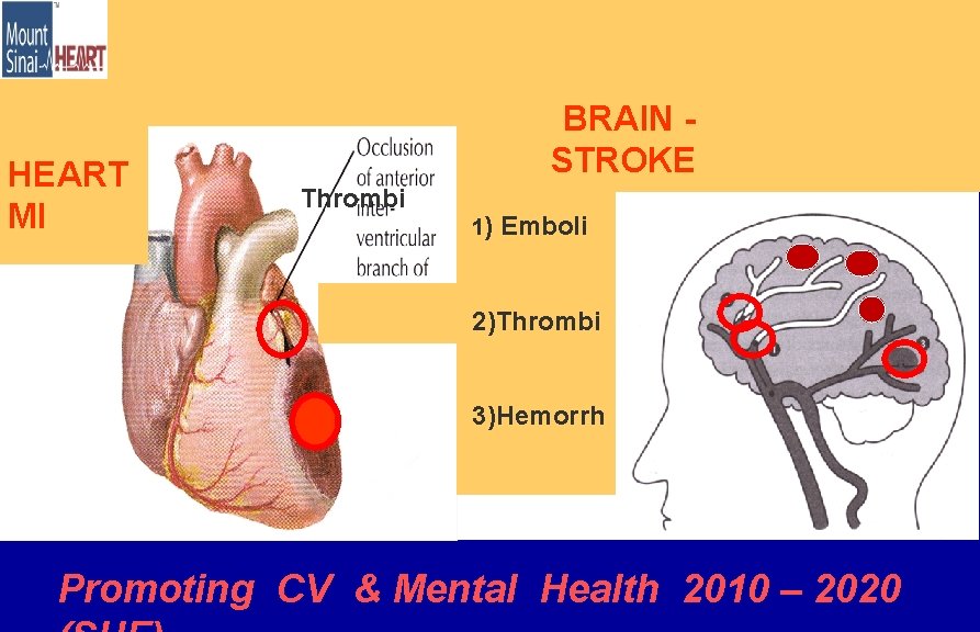 HEART MI BRAIN STROKE Thrombi 1) Emboli 2 2)Thrombi 3)Hemorrh Promoting CV & Mental
