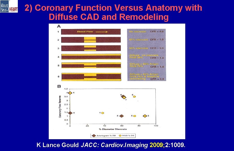 2) Coronary Function Versus Anatomy with Diffuse CAD and Remodeling K Lance Gould JACC: