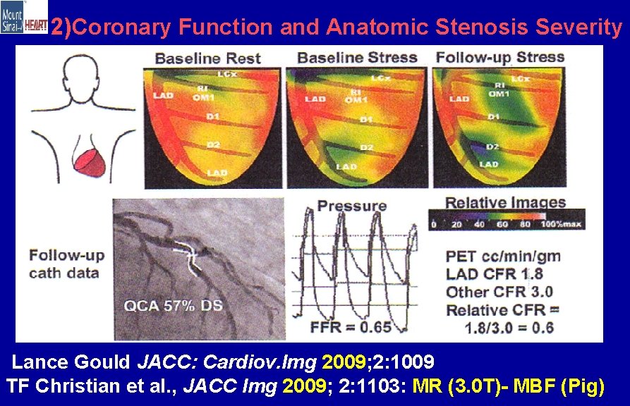 2)Coronary Function and Anatomic Stenosis Severity Lance Gould JACC: Cardiov. Img 2009; 2: 1009