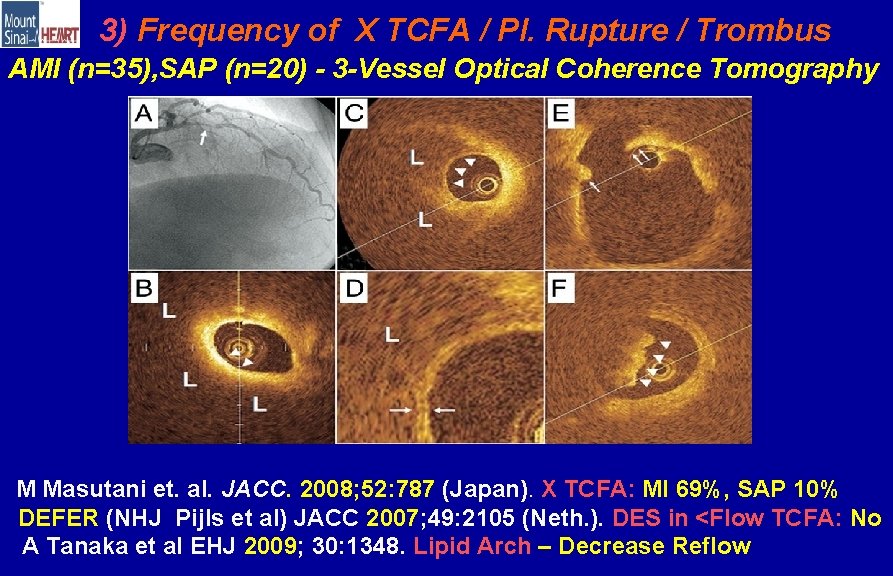 3) Frequency of X TCFA / Pl. Rupture / Trombus AMI (n=35), SAP (n=20)