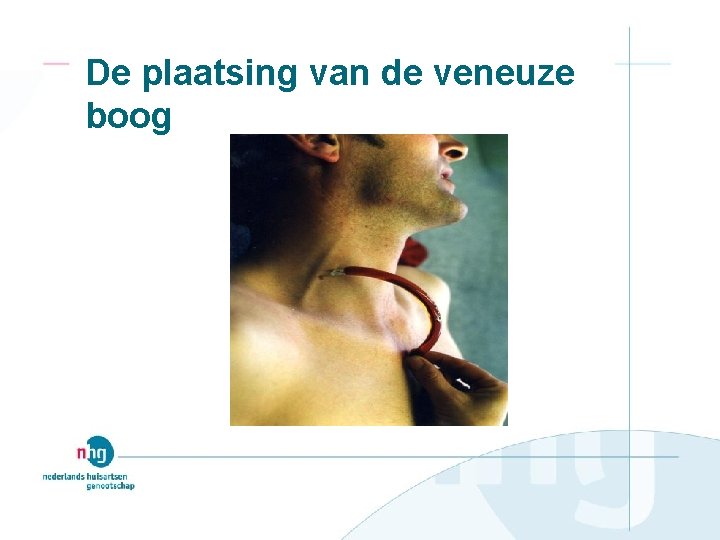 De plaatsing van de veneuze boog 