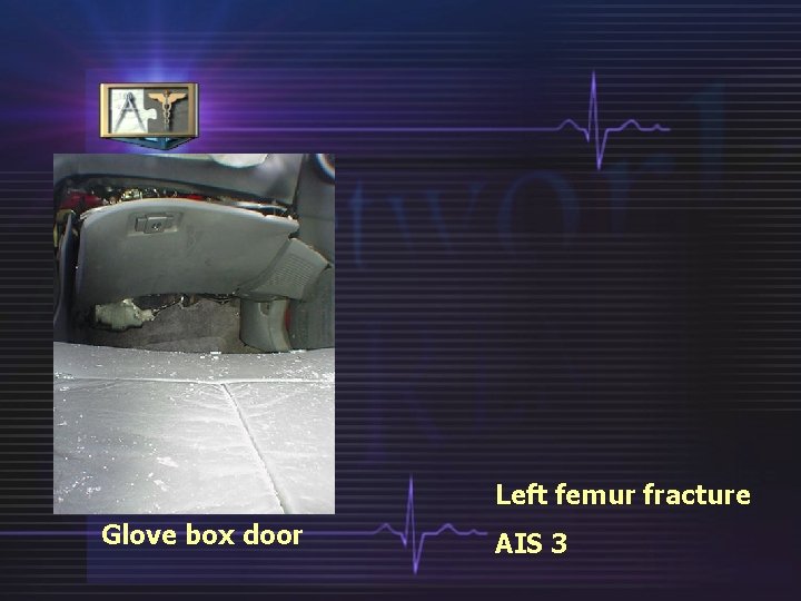 Left femur fracture Glove box door AIS 3 