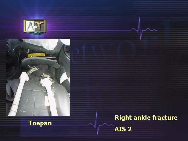 Toepan Right ankle fracture AIS 2 