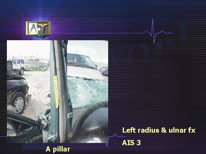 Left radius & ulnar fx A pillar AIS 3 