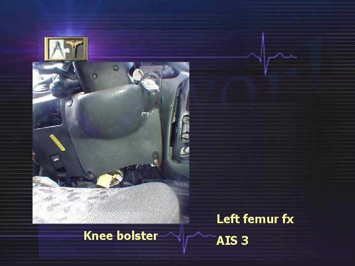 Left femur fx Knee bolster AIS 3 