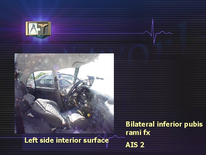 Left side interior surface Bilateral inferior pubis rami fx AIS 2 