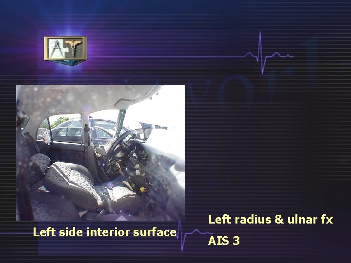Left side interior surface Left radius & ulnar fx AIS 3 