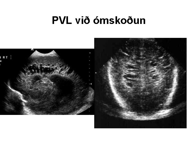 PVL við ómskoðun 