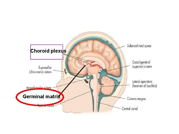 Choroid plexus Germinal matrix 