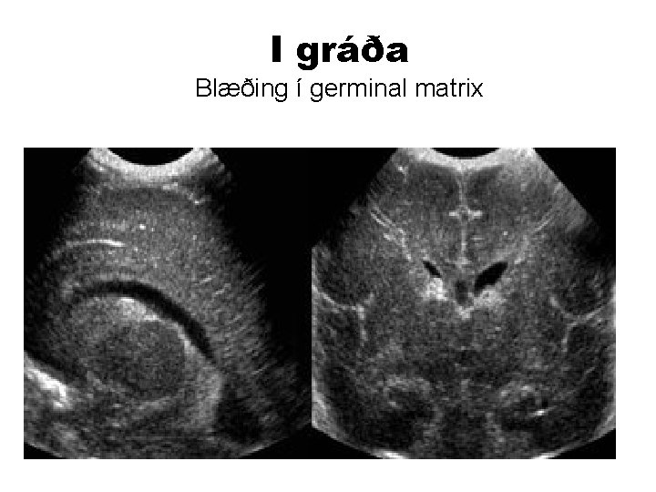 I gráða Blæðing í germinal matrix 