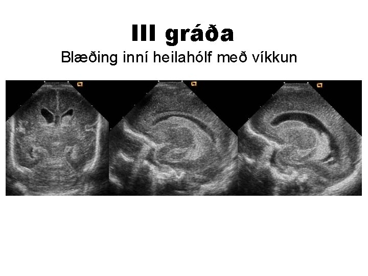 III gráða Blæðing inní heilahólf með víkkun 