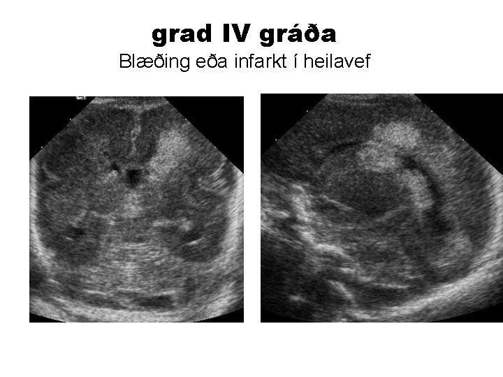 grad IV gráða Blæðing eða infarkt í heilavef 