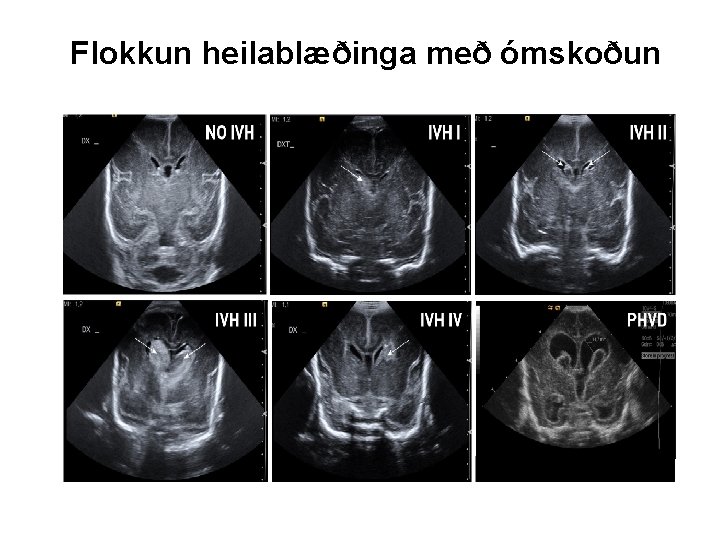Flokkun heilablæðinga með ómskoðun 