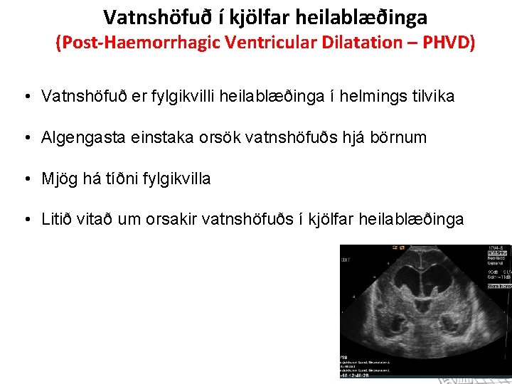 Vatnshöfuð í kjölfar heilablæðinga (Post-Haemorrhagic Ventricular Dilatation – PHVD) • Vatnshöfuð er fylgikvilli heilablæðinga