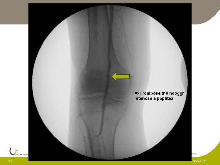 =>Trombose thv hooggr stenose a poplitea => 12 26 -5 -2021 