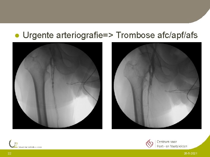 l 22 Urgente arteriografie=> Trombose afc/apf/afs 26 -5 -2021 