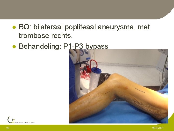 l l 26 BO: bilateraal popliteaal aneurysma, met trombose rechts. Behandeling: P 1 -P