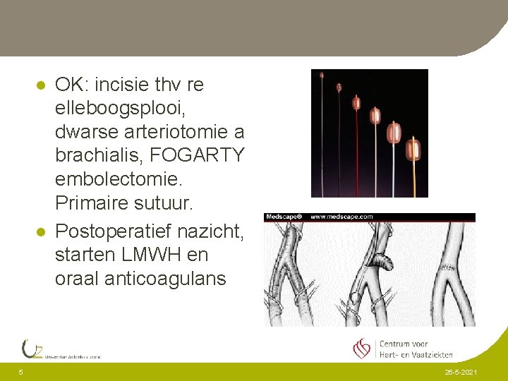 l l 5 OK: incisie thv re elleboogsplooi, dwarse arteriotomie a brachialis, FOGARTY embolectomie.