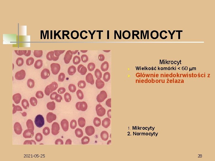 MIKROCYT I NORMOCYT Mikrocyt Ø Ø Wielkość komórki < 60 mm Głównie niedokrwistości z