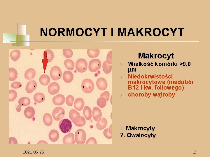 NORMOCYT I MAKROCYT Makrocyt Ø Ø Ø Wielkość komórki >9, 0 mm Niedokrwistości makrocytowe