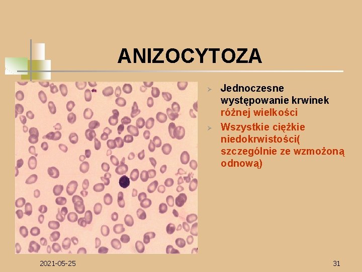 ANIZOCYTOZA Ø Ø 2021 -05 -25 Jednoczesne występowanie krwinek różnej wielkości Wszystkie ciężkie niedokrwistości(