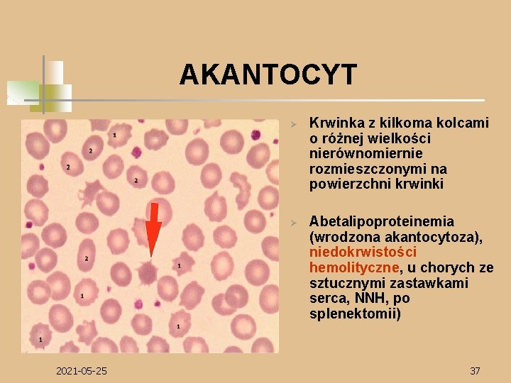 AKANTOCYT Ø Ø 2021 -05 -25 Krwinka z kilkoma kolcami o różnej wielkości nierównomiernie