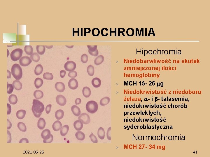 HIPOCHROMIA Hipochromia Ø Ø Ø Niedobarwliwość na skutek zmniejszonej ilości hemoglobiny MCH 15 -