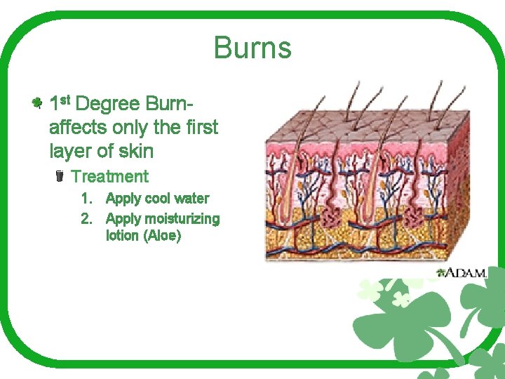 Burns 1 st Degree Burnaffects only the first layer of skin Treatment 1. Apply