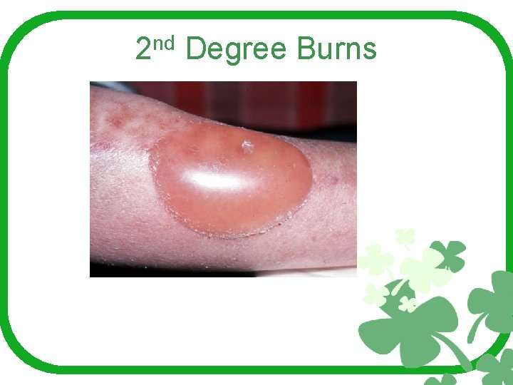 2 nd Degree Burns 